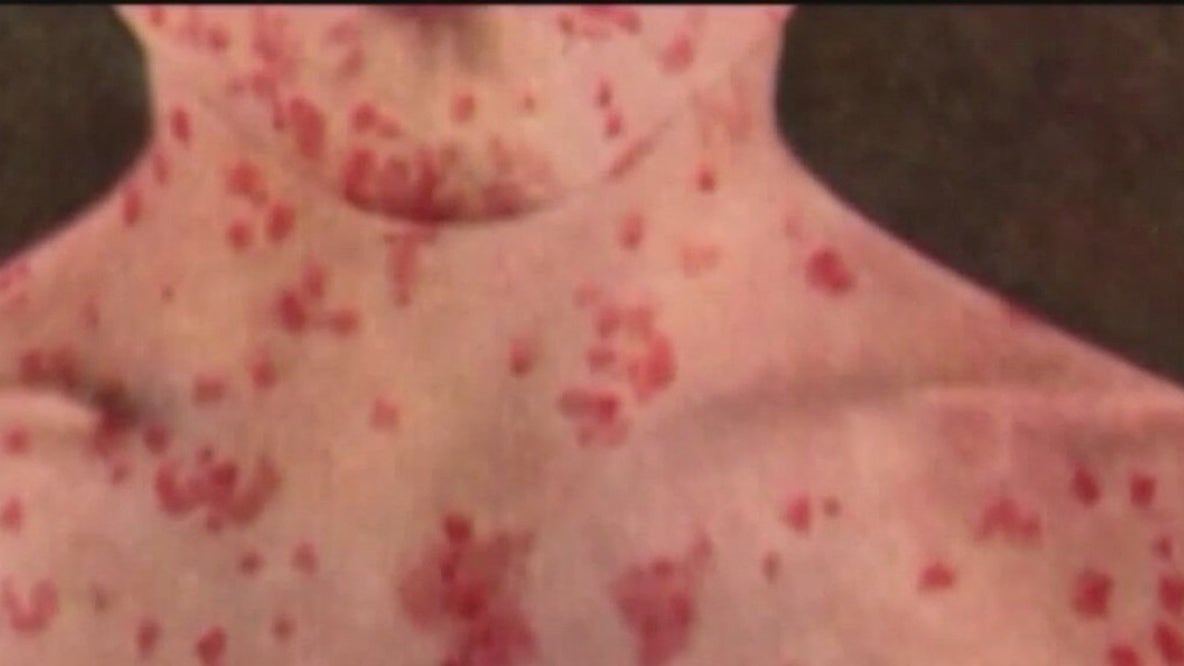 Measles cases rising nationwide